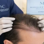 Consulta médica revisando el crecimiento del pelo injertado mes a mes en una clínica de Córdoba