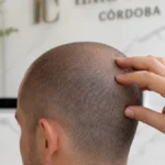 Yemas de los dedos masajeando suavemente un cuero cabelludo con pelo corto en una clínica de injerto capilar luminosa en Córdoba, sobre mostrador de mármol, simbolizando cuándo se puede masajear tras la intervención